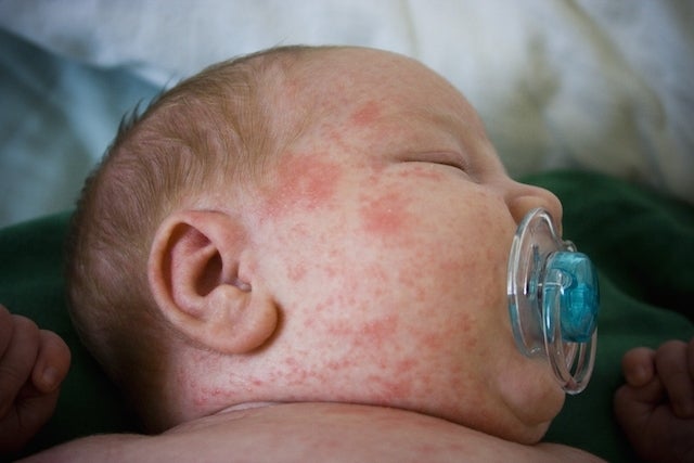 Como evitar alergias em pele de bebê